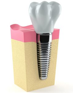 Diagram of a dental implant, in a jawbone, that has a tooth-colored dental crown attached to the top of it