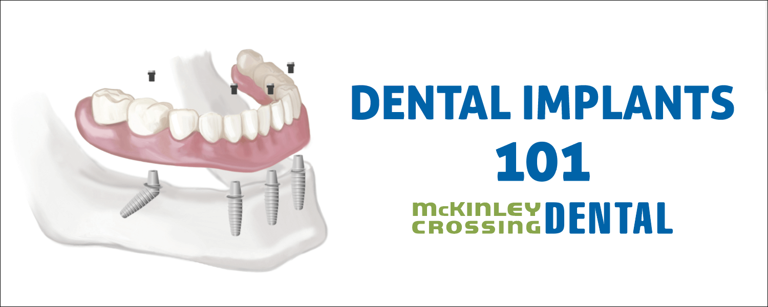 clauser-dental-implants-101