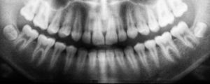 teeth x-ray for cavities